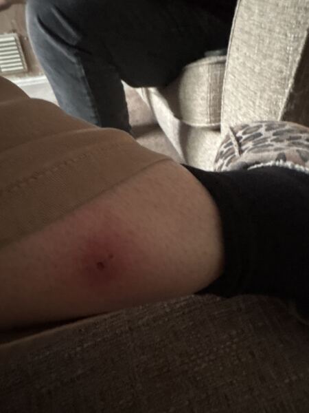 Insect bites TMI pics included