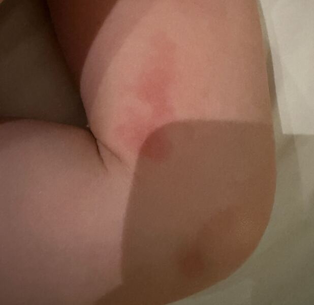 Redness on thigh of 3 year old