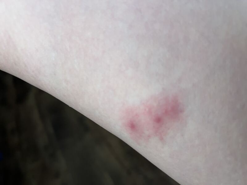 Bed bugs!