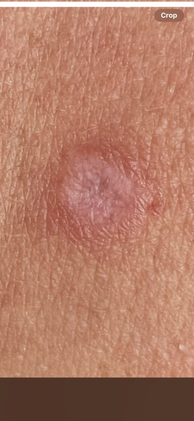 Anxious about chest mark before appointment, could it be skin cancer?