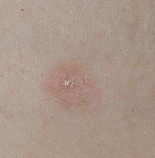 Does this look like ringworm even without a ring around it?