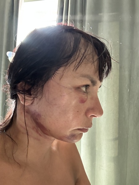 Is it normal to feel guilty before a planned facelift?