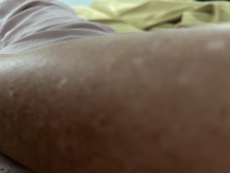 Does anyone know what these white marks on my arms are?