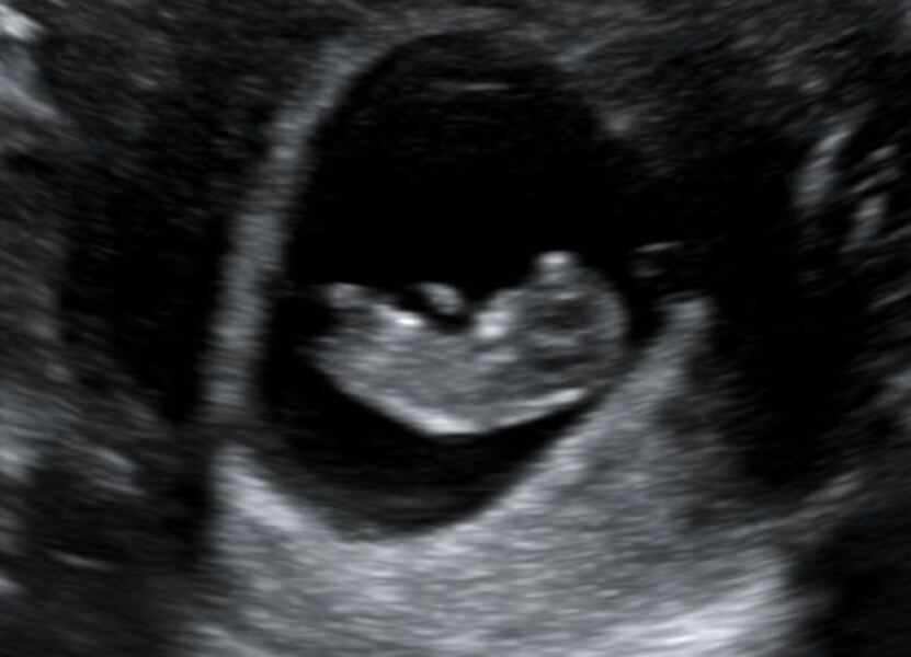 10 weeks any clues? 💗💙
