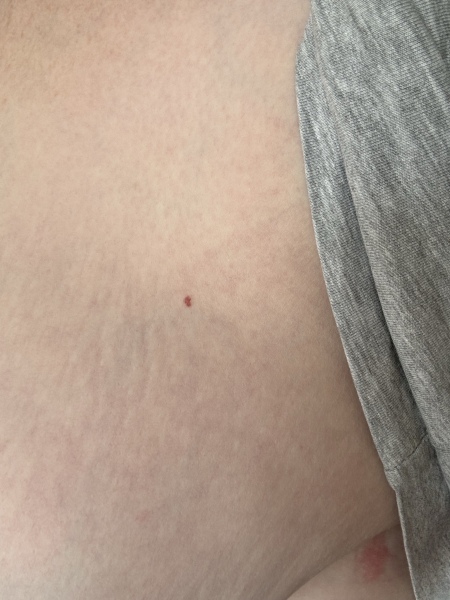 2week red flag referral