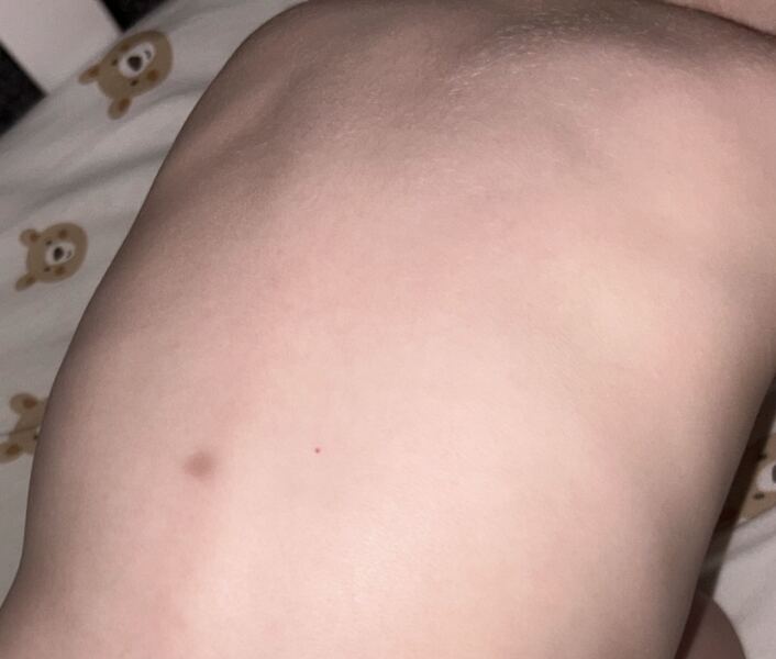 Unexplained bruise on babies back HELP