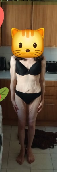 How do others feel about loose skin after major weight loss? pic including tmi warning