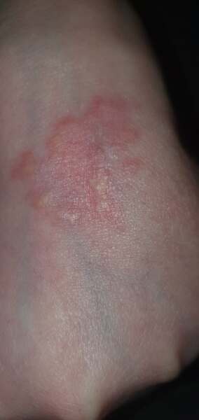 Any dermatology people on here please