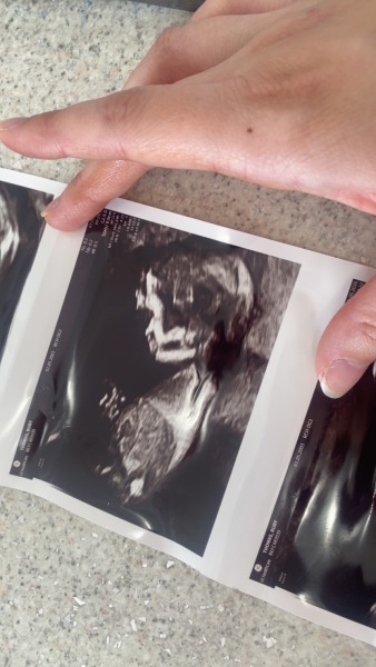 Nub theory boy or girl? 13 weeks