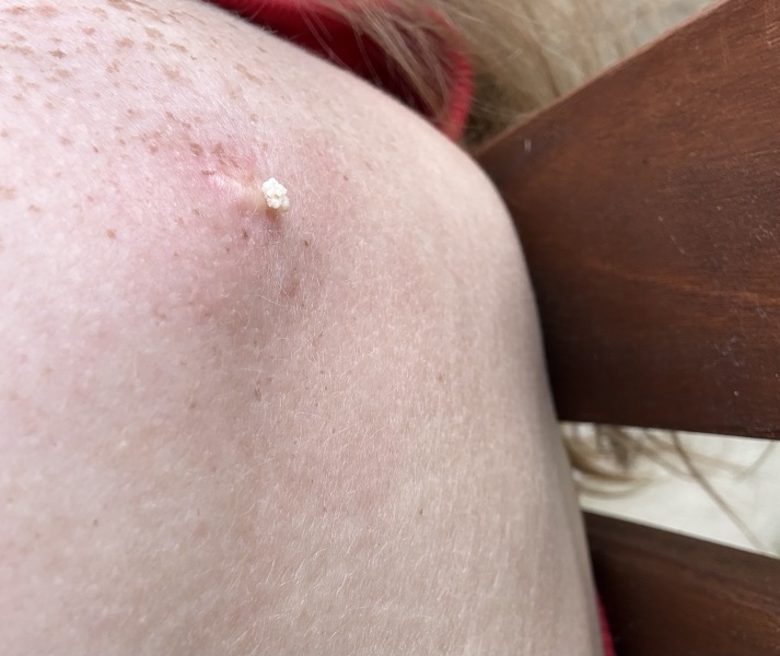 Pictures of recent sebaceous cyst contents