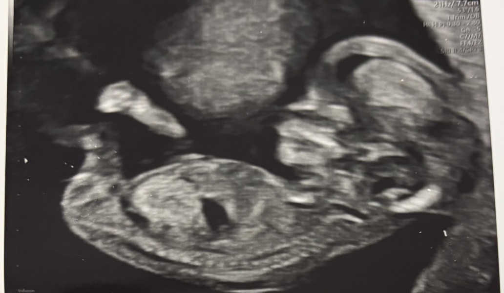 Nub theory guesses at 13+1 weeks pregnant