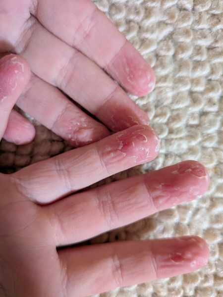 Child's fingertips peeling skin