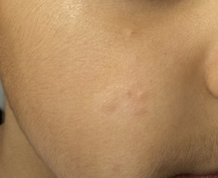 Rash on 5yo Face