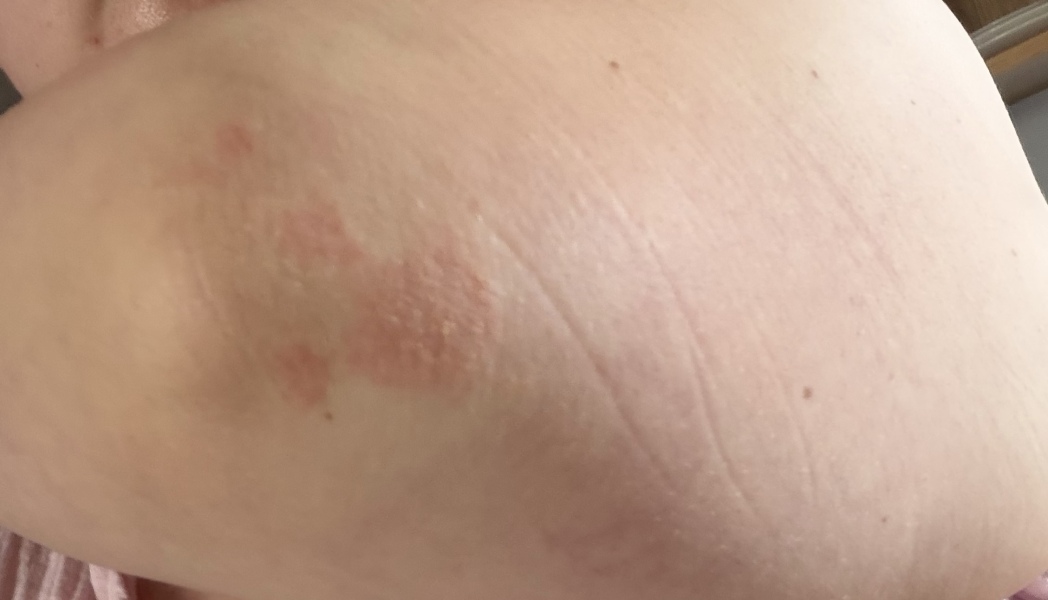 How can I fake tan around this patch of skin?!