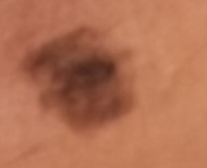 Concerns over a freckle type thing on my leg