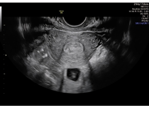 Negative pregnancy test, possible polyp and unusual scan findings