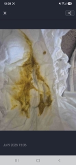CMPA query *[Content warning: nappy pics included]