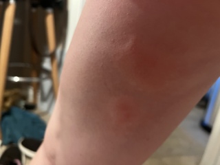 Insect bites TMI pics included