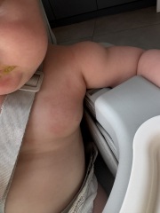 Recurring skin sores on my six month old, any ideas?