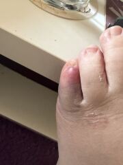 Broken (I think) toe