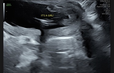 Do these 17-week scan photos suggest a girl to you too?