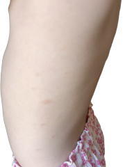 To ask if anyone knows what these blemishes could be on my daughter?