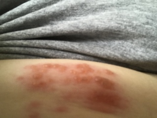 Possible shingles ? Pic attached cluster of 12 red spots