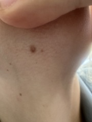 Mole 2ww