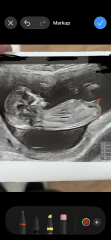 Can anyone help interpret my scan and nub theory guess?