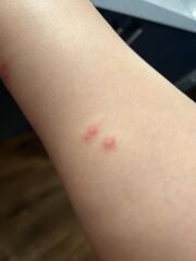 Bed bugs!