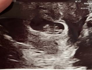 Any guesses on gender using Ramzi theory at 8 weeks +4 scan