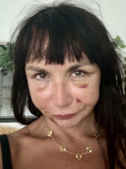 Awaiting facelift surgery tomorrow, and would appreciate positive thoughts and advice