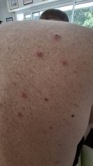 Are these bedbug bites?
