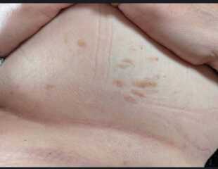 GP for these moles?
