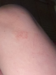 To have a face to face doctors appointment for this?