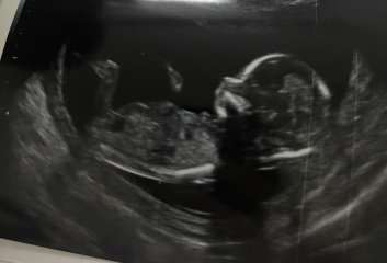 Doubts after a rushed 15-week gender scan showing a possible boy