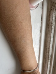 Does anyone know what these white marks on my arms are?
