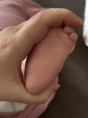 Baby rash on feet