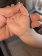 Rash after 18 month jabs or possible chickenpox, HFM or infection?