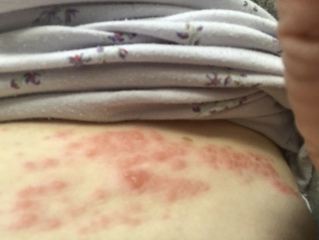 Possible shingles ? Pic attached cluster of 12 red spots