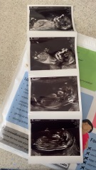 Nub theory boy or girl? 13 weeks