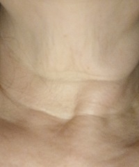 Any non-invasive treatments or exercises that help improve neck skin?