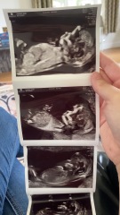 Nub theory boy or girl? 13 weeks