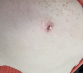 Pictures of recent sebaceous cyst contents