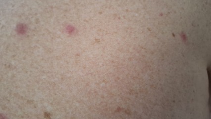 Are these bedbug bites?