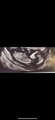 Pregnancy after loss
