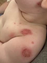 Recurring skin sores on my six month old, any ideas?