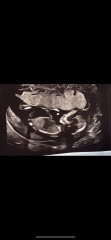 Pregnancy after loss