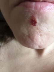 DD 17 mole with black hairs sprouting from it mole is fine can anything be done about the hair ?