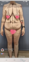 Anyone considering a tummy tuck after losing weight with injections?